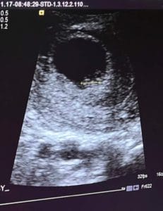 becoming-a-mom-again-after-Essure-reversal