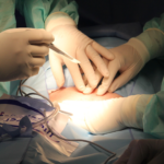 have-you-wondered-what-to-expect-with-essure-removal-surgery
