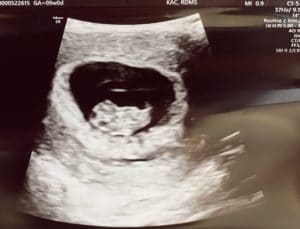 pregnancy-is-possible-with-one-tube-reversed-after-tubal-reversal