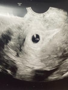 filshie-clip-tubal-reversal-southern-pines-north-carolina