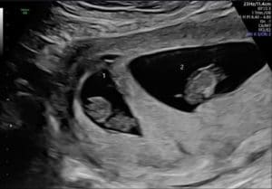 oregon-essure-reversal-mom-has-twins-after-reversing-essure-with-dr-monteith