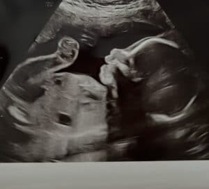 second-tubal-reversal-baby-hollywoood-florida-after-reversing-burned-tubes
