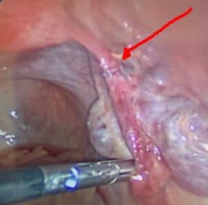 chromopertubation-during-laparoscopy-showing-blocked-fallopian-tube