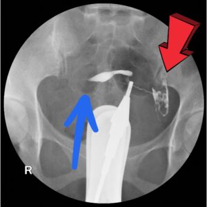 HSG-xray-showing-open-fallopian-tube-and-fallopian-tube-spasm