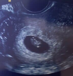 Cincinnati-oh-tubal-reversal-baby