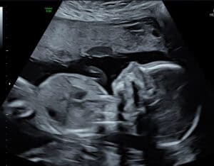 quick-pregnancy-after-tubal-reversal-surgery