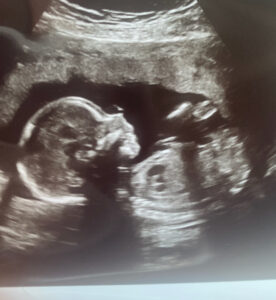 southern-pines-nc-tubal-clip-reversal-baby