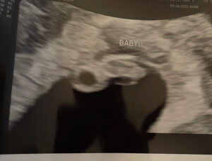 dreams-came-true-after-greensboro-nc-mom-has-tubal-reversal-surgery