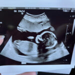 20-week-scan-Essure-reversal-baby
