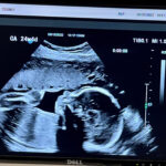 tubal-ring-reversal-baby-boy-24-weeks-johnstown-pa