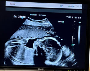 tubal-ring-reversal-baby-boy-24-weeks-johnstown-pa