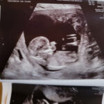 13-weeks-pregnant-after-tubal-reversal-milford-iowa