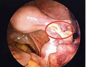 tubal-coagulation-is-burning-fallopian-tubes