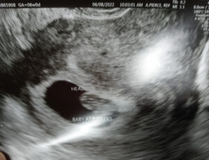 linwood-north-carolina-tubal-reversal-baby