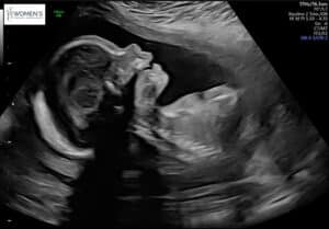 Mississippi-tubal-reversal-surgery-with-dr-monteith-third-trimester