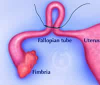 pomeroy-is-a-type-of-tubal-ligation