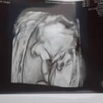 20-week-ultrasound-after-tubal-ligation-reversal