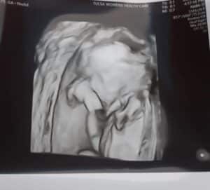 20-week-ultrasound-after-tubal-ligation-reversal