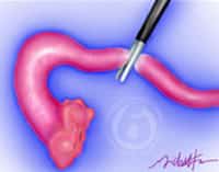 bipolar-tubal-coagulation-can-also-be-reversed