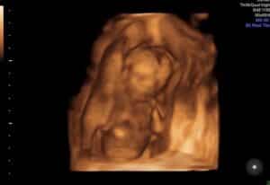 confirmed-baby-girl-at-16-weeks