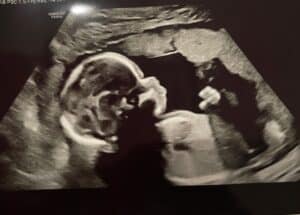 Greensboro-North Carolina-tubal-reversal-ultrasound