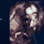 one-tube-repaired-pregnancy-happened-North-Wilkesboro-nc