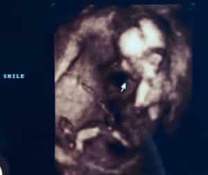 one-tube-repaired-pregnancy-happened-North-Wilkesboro-nc