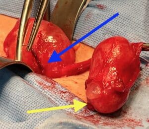 essure-device-perforating-uterine-muscle-and-pyosalpinx