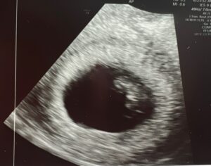 tubal-reversal-baby-from-Darlington-South-Carolina