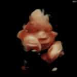 31-weeks-after-reversing-tubal-clips-dumfries-va