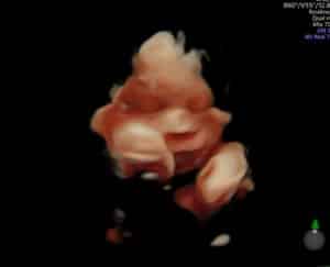 31-weeks-after-reversing-tubal-clips-dumfries-va