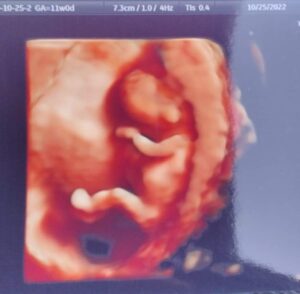 tubal-clip-reversal-inwood-west-virginia