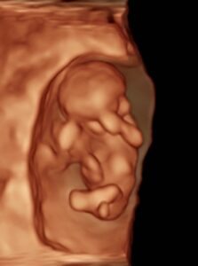 Sioux-city-iowa-tubal-reversal-baby-with-reversal-of-tubal-clips