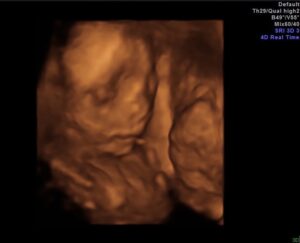 tubal-reversal-baby-from-wilmington-nc