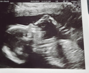 excited-to-meet-our-tubal-reversal-baby-girl