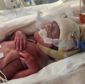 baby-from-santa-ana-california-born-early-after-reversal