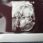 19-weeks-ultrasound-after-succesful-tubal-reversal-surgery