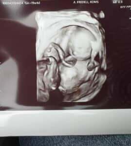 19-weeks-ultrasound-after-succesful-tubal-reversal-surgery