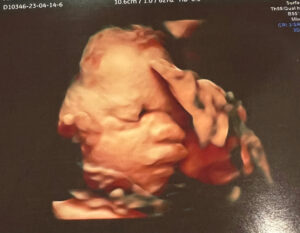 Hampton-virginia-vasectomy-reversal-baby