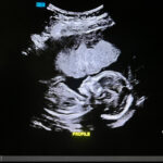 13-weeks-pregnant-after-reversing-tubal-clip-tubal-ligation