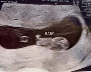Charleroi-pa-essure-reversal-baby-progressing