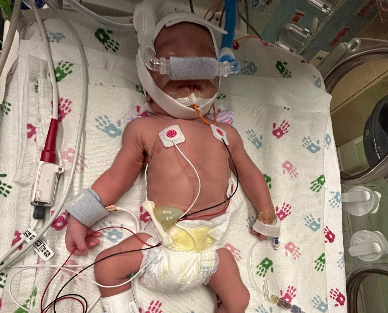 tubal-reversal-baby-from-chicago-illinois-born-at-32-weeks-gestation