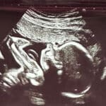 21-weeks-pregnant-after-reversing-tubal-clips