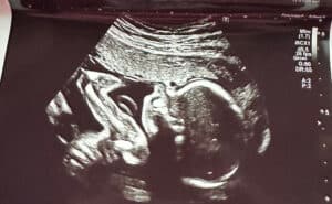 21-weeks-pregnant-after-reversing-tubal-clips