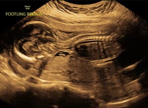 removing-fallopian-tube-bands-Sharps-Chapel-TN