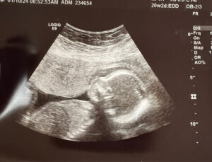 pregnant-first-cycle-after-tubal-reversal-surgery-dryfork-west-virginia