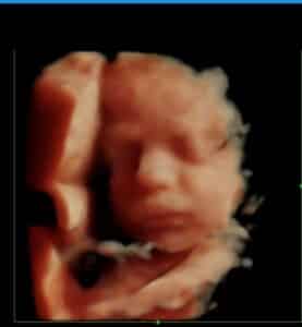 33-weeks-pregnant-with-third-essure-reversal-baby