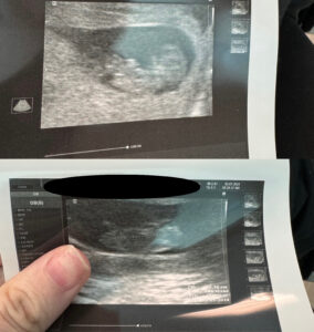 tubal-reversal-twins-from-McMinnville-TN-after-tubal-reversal-with-dr-monteith