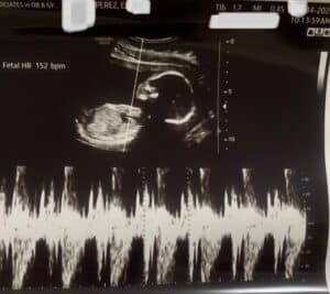 tubal-reversal-baby-from-dalton-georgia