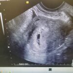 intra-uterine-tubal-reversal-baby-from-lenoir-tennessee